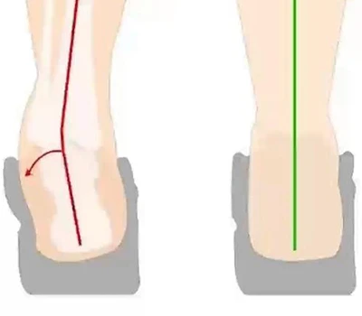 Posouzení obracení paty a inverze paty: klinické hodnocení, praktické aplikace a komerční integrace