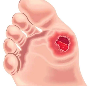 Hodnocení diabetické nohy: Klinický náhled, řízení rizik a komerční příležitosti