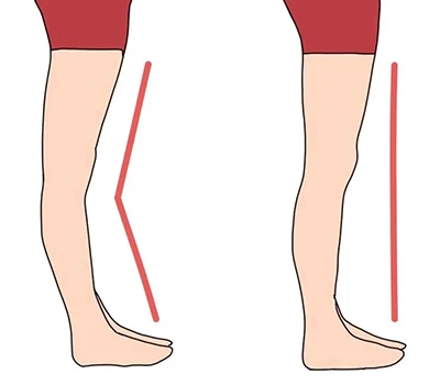 Genu Recurvatum Assessment and Correction: Klinická a komerční příručka pro moderní postupy