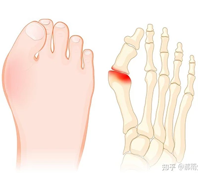 Hallux Valgus: Kompletní vědecký průvodce