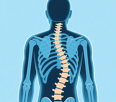 Scoliosis: Xianku 3D skener těla, 3D+AI, prevence a korekce skoliózy