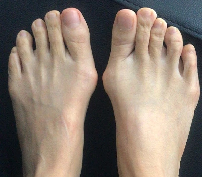 Měření Hallux Valgus: Proč 3D skenery převyšují kliniky a nemocnice