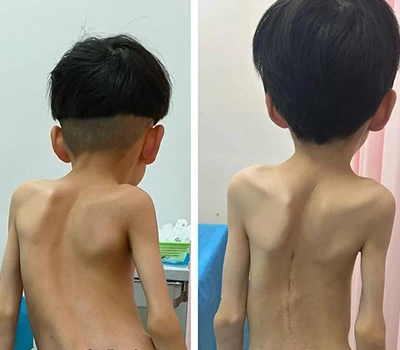 Zdraví páteře: Role technologie 3D skenování těla při hodnocení skoliózy a transformaci trhu