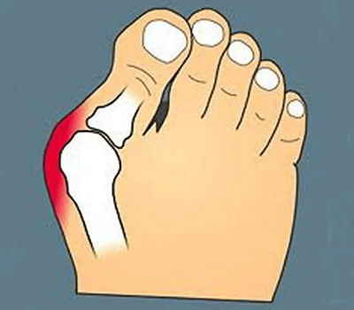 Transforming Bunion Care: Integrace přesného skenování pro vylepšené přizpůsobení, zapojení pacie...